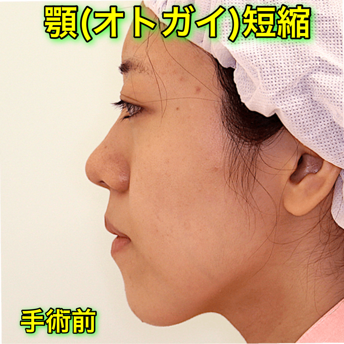 顎削り（オトガイ短縮＆前方移動）｜ビフォーアフター症例写真