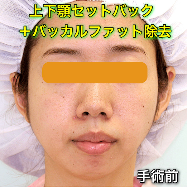 上下セットバックの症例写真（Before After）