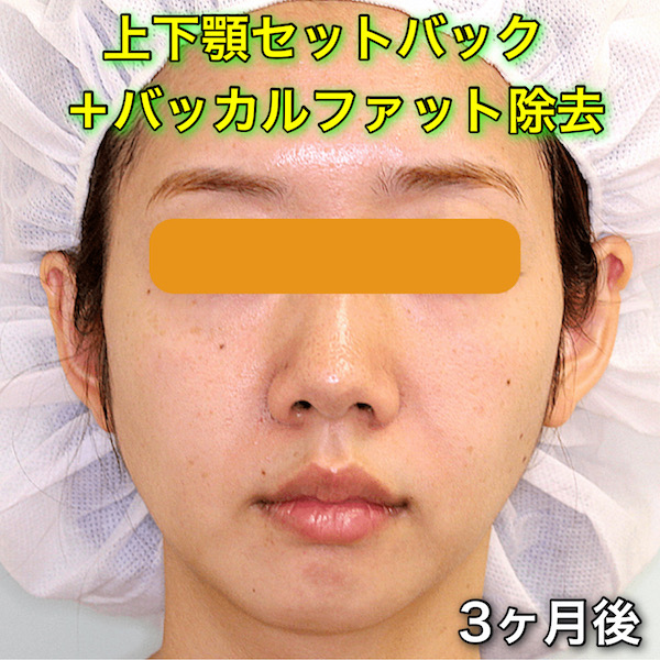 上下セットバックの症例写真（Before After）