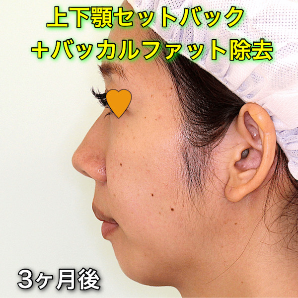 上下セットバックの症例写真（Before After）