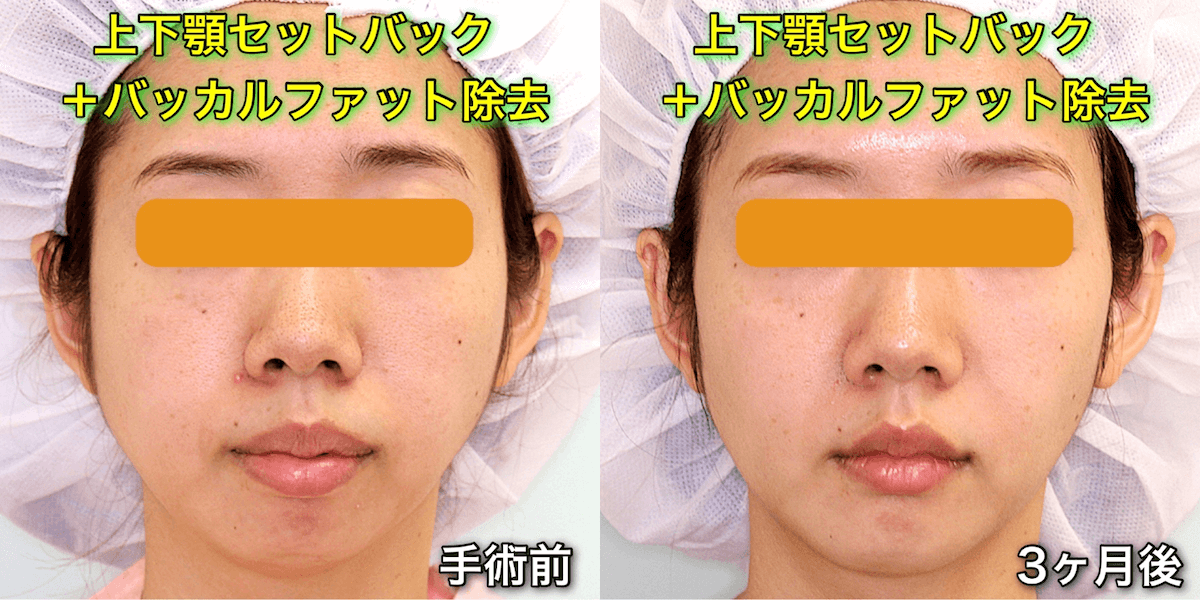 上下顎セットバックのビフォーアフター症例写真