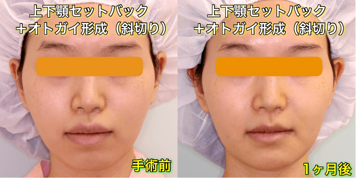 上下顎セットバックのビフォーアフター症例写真