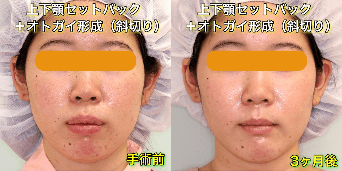 上下顎セットバックのビフォーアフター症例写真