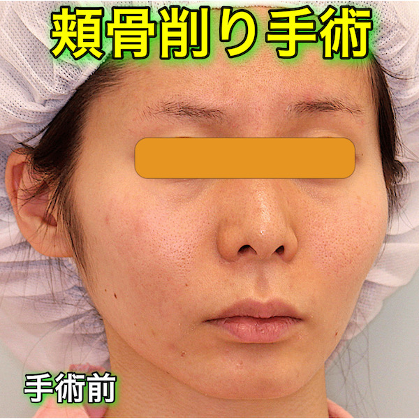 頬骨削り手術の症例写真（BeforeAfter）