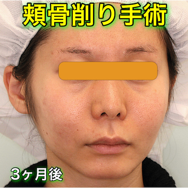 頬骨削り手術の症例写真（BeforeAfter）