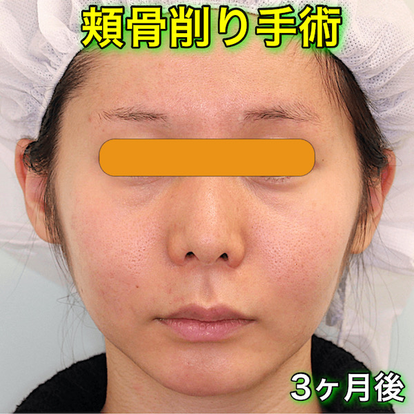 頬骨手術のビフォーアフター症例写真