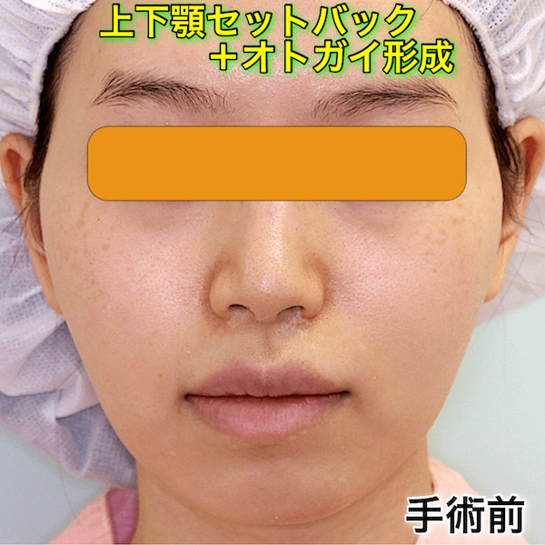 上下顎セットバック+オトガイ形成の症例写真（BeforeAfter）