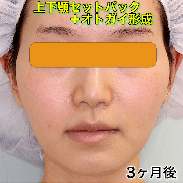 上下顎セットバック+オトガイ形成の症例写真（BeforeAfter）