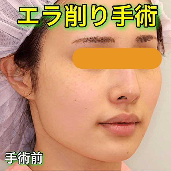 エラ削り手術のビフォーアフター奨励写真