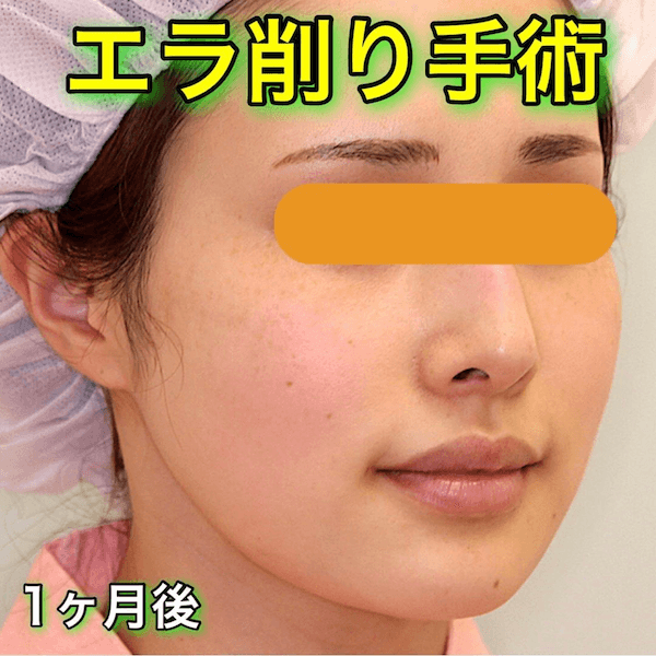エラ削り手術のビフォーアフター奨励写真