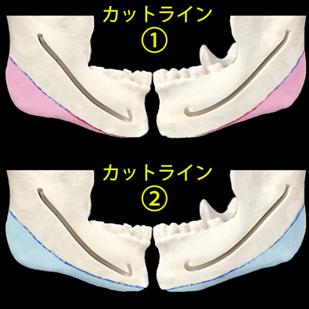 エラ削り手術のビフォーアフター（症例写真）