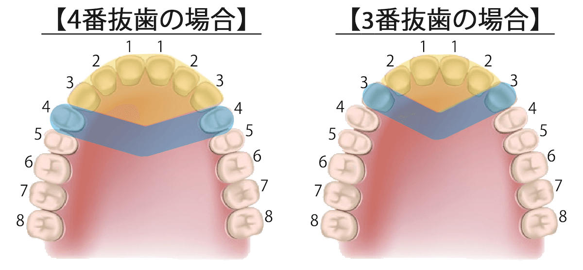 上下顎セットバック｜抜歯3番4番