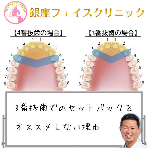 上下顎セットバック｜抜歯3番4番