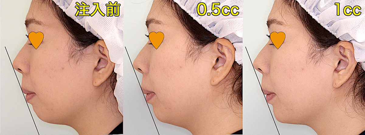 顎ヒアルロン酸・Eライン付き