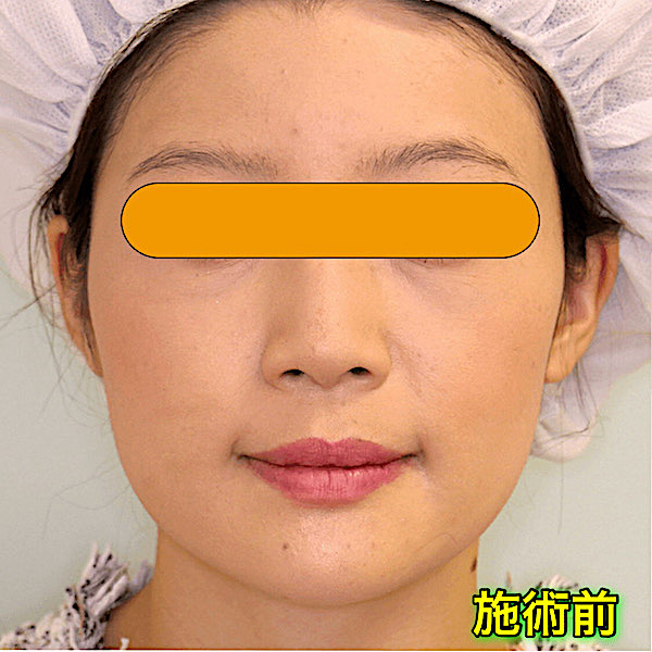 脂肪溶解注射（カベリン）の症例写真｜ビフォーアフター（BeforeAfter）