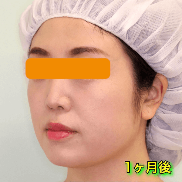 脂肪溶解注射（カベリン）の症例写真｜ビフォーアフター（BeforeAfter）