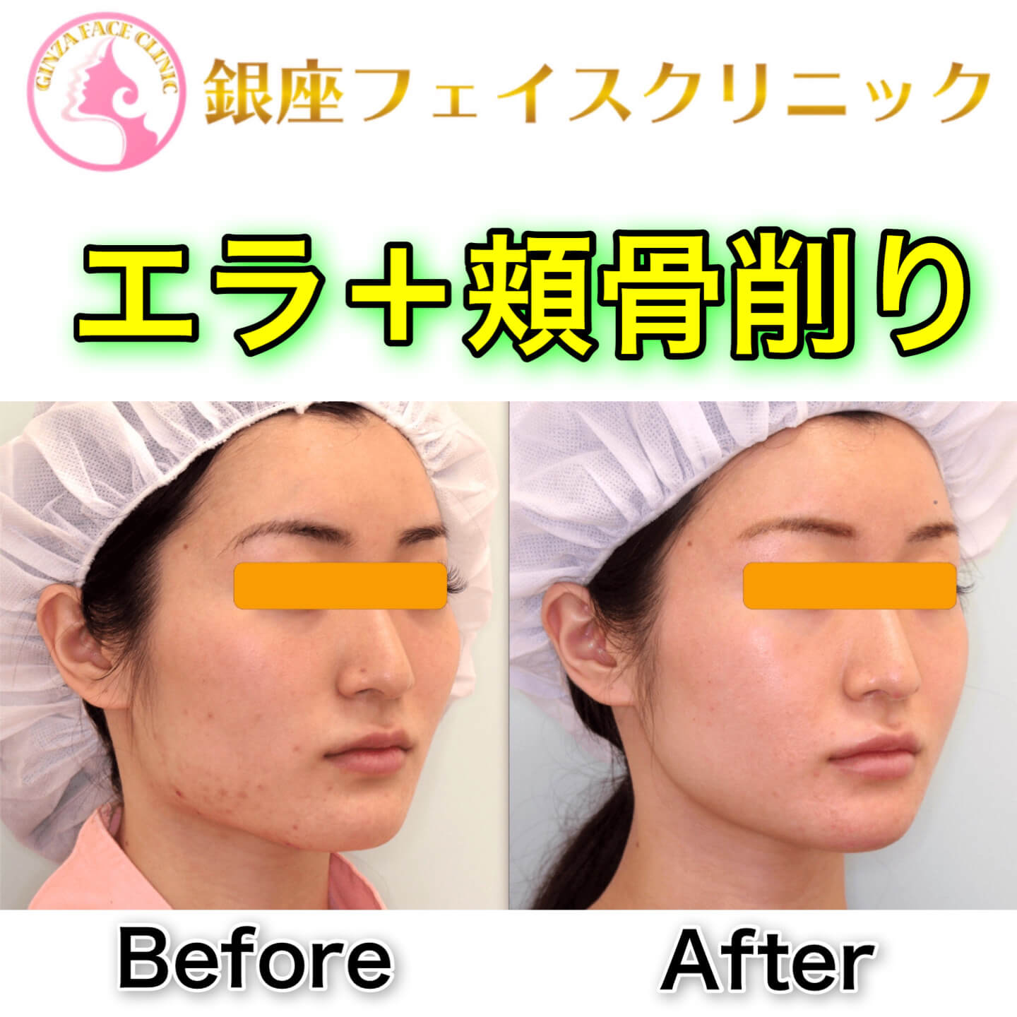 輪郭2点手術のビフォーアフター症例写真（頬骨＋エラ）