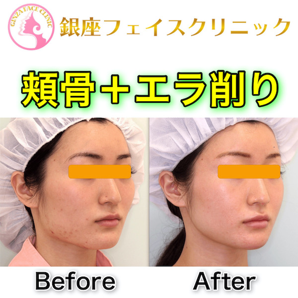 症例写真 頬骨 エラ削り 小顔整形 輪郭整形専門の美容外科 銀座フェイスクリニック