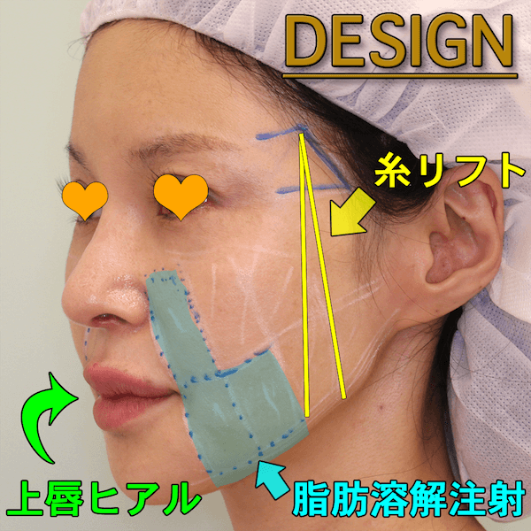 糸のリフト（ミントリフト）+脂肪溶解注射の症例写真（ビフォーアフター