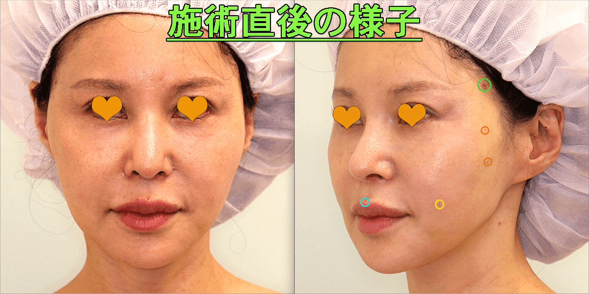 糸のリフト（ミントリフト）+脂肪溶解注射の症例写真（ビフォーアフター）施術直後の写真