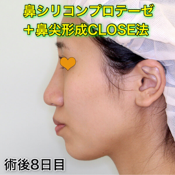 鼻プロテーゼ＋鼻尖形成CLOSE法