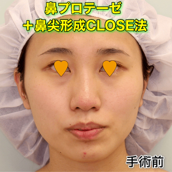 鼻プロテーゼ＋鼻尖形成CLOSE法の症例写真（ビフォーアフター）