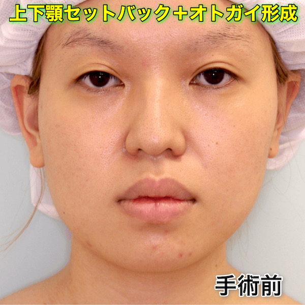 上下顎セットバック＋オトガイ形成の症例写真（ビフォーアフター）