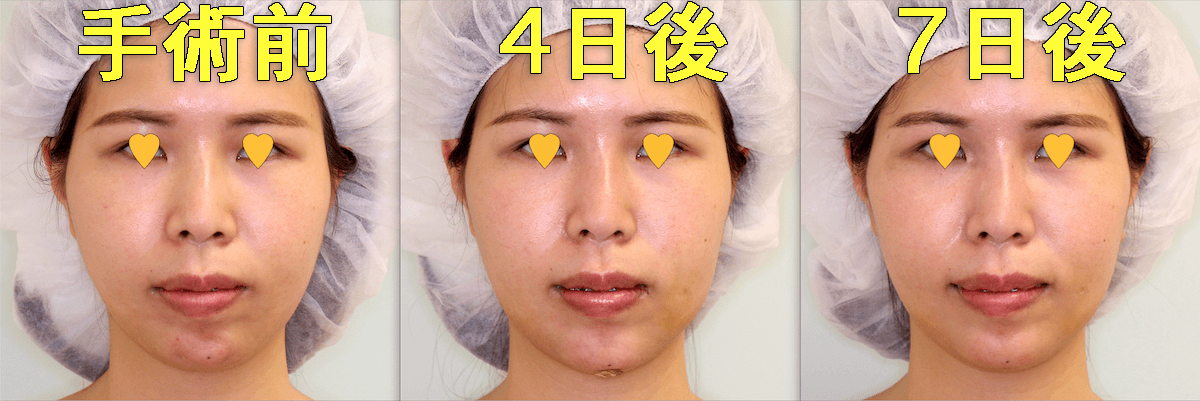 あごプロテーゼ＋ジョールファット除去｜術後1週間のビフォーアフターとダウンタイム