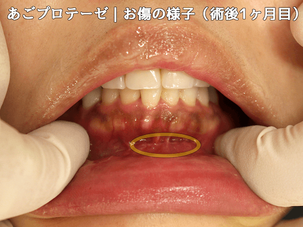 あごプロテーゼ｜お傷の様子（1ヶ月目）2