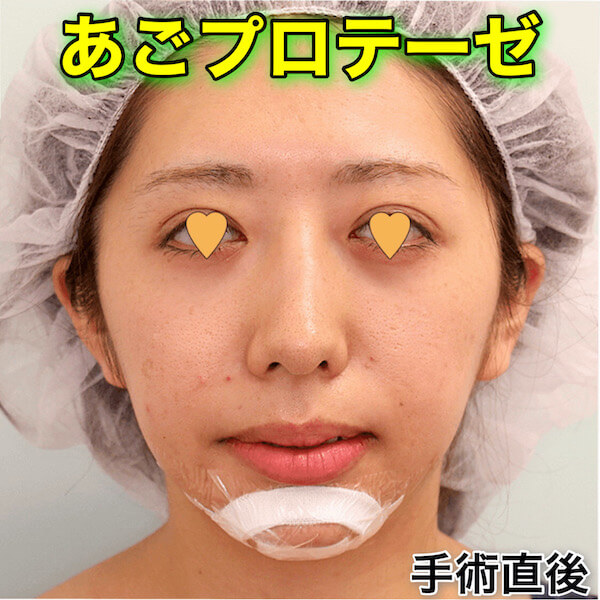 あごプロテーゼの症例写真（ビフォーアフター）