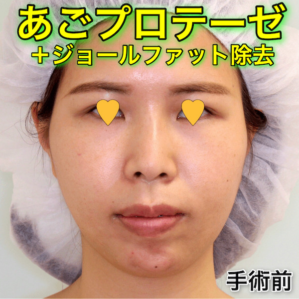 あごプロテーゼ＋ジョールファット除去｜術後1週間のビフォーアフターとダウンタイム