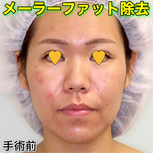 メーラーファット除去のダウンタイム（症例写真）
