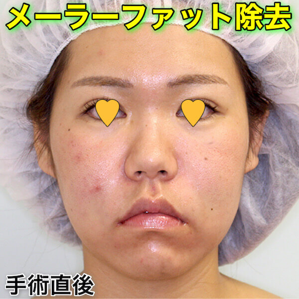 メーラーファット除去のダウンタイム（症例写真）