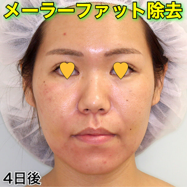 メーラーファット除去のダウンタイム（症例写真）