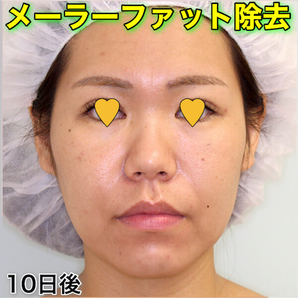 メーラーファット除去のダウンタイム（症例写真）