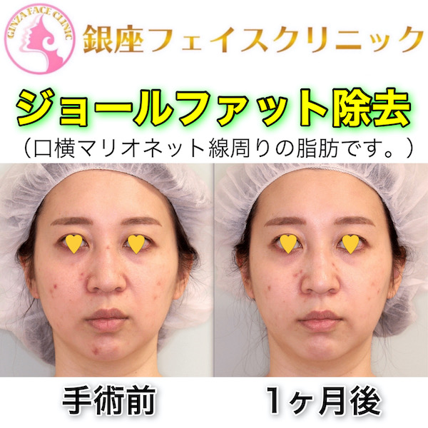ジョールファット除去の症例写真（ビフォーアフター）