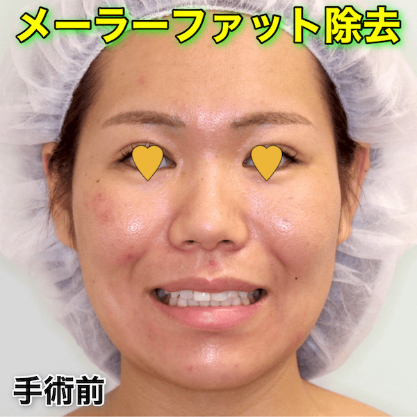 メーラーファット除去のビフォーアフター症例写真