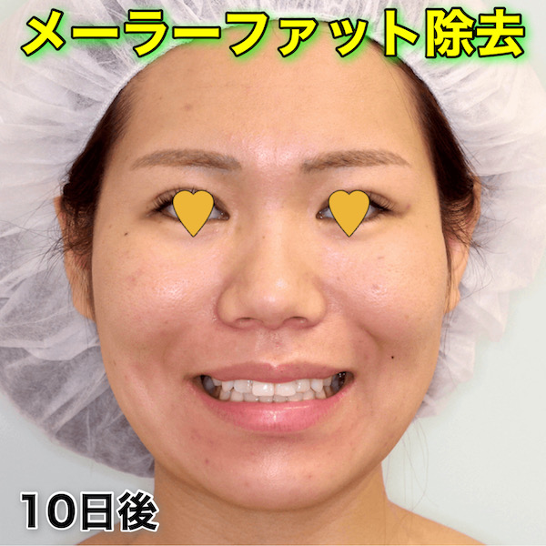 メーラーファット除去のビフォーアフター症例写真