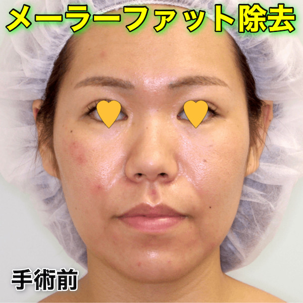 メーラーファット除去のビフォーアフター症例写真