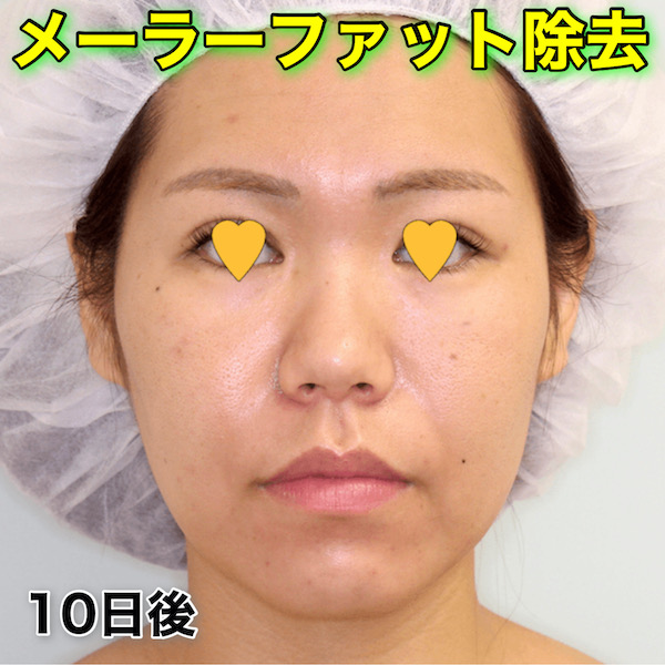 メーラーファット除去のビフォーアフター症例写真