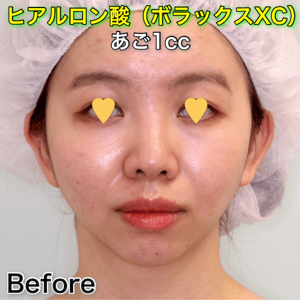 あごヒアルロン酸（ボラックスXC）のビフォーアフター症例写真
