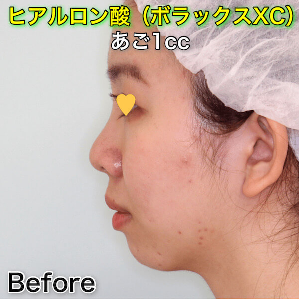 あごヒアルロン酸（ボラックスXC）のビフォーアフター症例写真