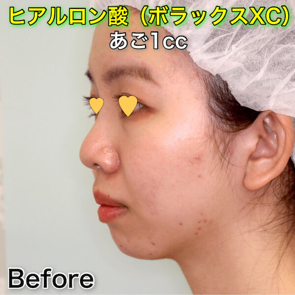 あごヒアルロン酸（ボラックスXC）のビフォーアフター症例写真