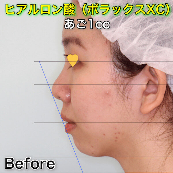 あごヒアルロン酸（あごフィラー）による横顔（Eライン）の変化｜ビフォーアフター症例写真