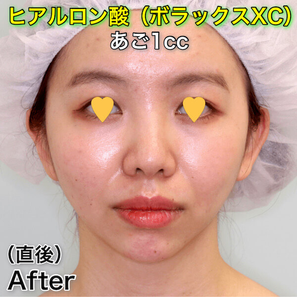 あごヒアルロン酸（ボラックスXC）のビフォーアフター症例写真