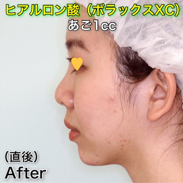 あごヒアルロン酸（ボラックスXC）のビフォーアフター症例写真