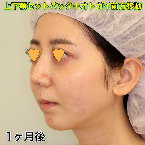 上下顎セットバック+オトガイ前方移動の症例写真（ビフォーアフター）