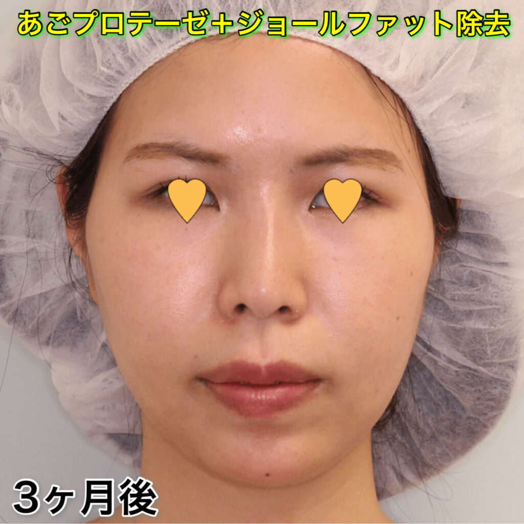 顎プロテーゼ+ジョールファット除去のビフォーアフター症例写真（3ヶ月後・正面）