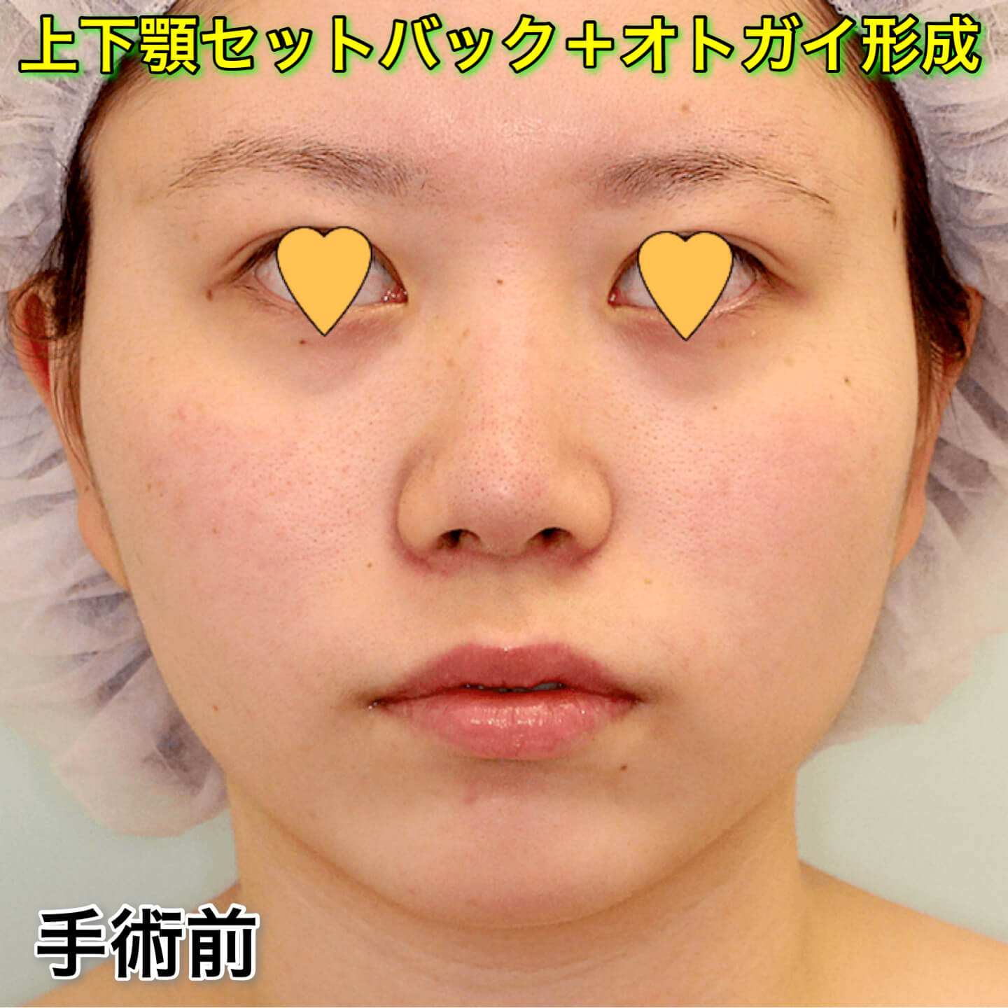 上下顎セットバック+オトガイ形成の症例写真（ビフォーアフター）