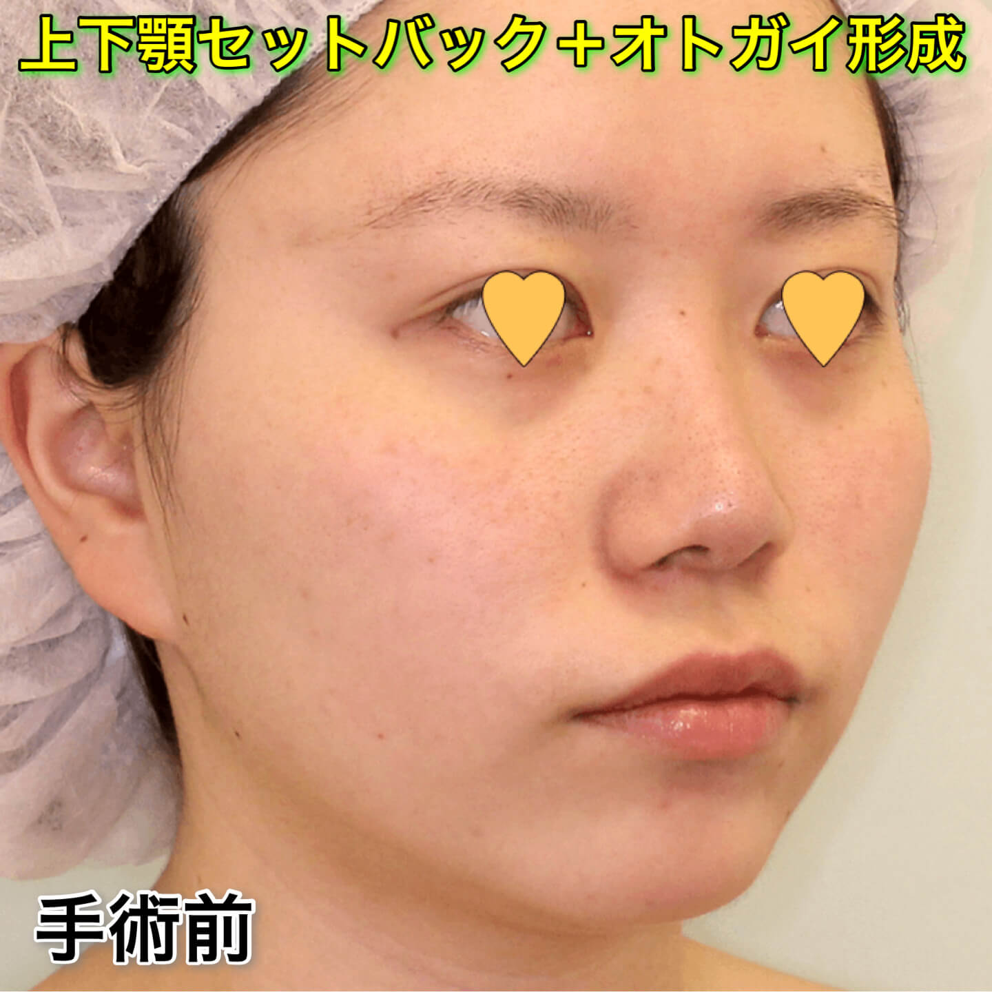 上下顎セットバック+オトガイ形成の症例写真（ビフォーアフター）
